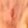 Incision-6-10-14-1.jpg